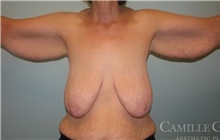 Arm Lift Before Photo by Camille Cash, MD; Houston, TX - Case 47679