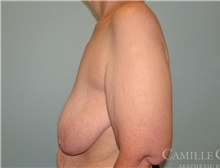 Arm Lift Before Photo by Camille Cash, MD; Houston, TX - Case 47679