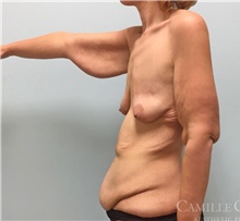 Arm Lift Before Photo by Camille Cash, MD; Houston, TX - Case 47681