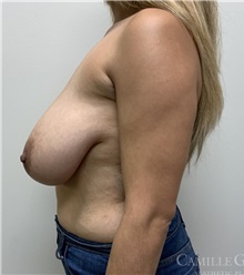 Breast Reduction Before Photo by Camille Cash, MD; Houston, TX - Case 47682