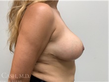 Breast Reduction After Photo by Camille Cash, MD; Houston, TX - Case 47682