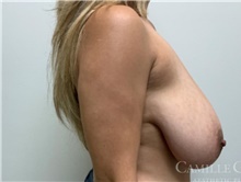 Breast Reduction Before Photo by Camille Cash, MD; Houston, TX - Case 47682