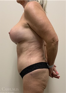 Body Contouring After Photo by Camille Cash, MD; Houston, TX - Case 47736