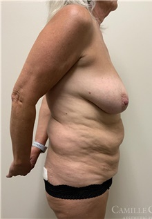 Body Contouring Before Photo by Camille Cash, MD; Houston, TX - Case 47736