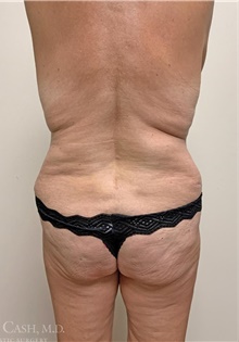 Body Contouring After Photo by Camille Cash, MD; Houston, TX - Case 47736