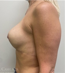 Breast Implant Revision After Photo by Camille Cash, MD; Houston, TX - Case 47749