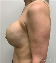 Breast Implant Revision Before Photo by Camille Cash, MD; Houston, TX - Case 47749