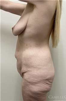 Body Contouring Before Photo by Camille Cash, MD; Houston, TX - Case 47750