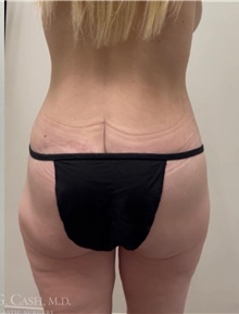 Body Contouring After Photo by Camille Cash, MD; Houston, TX - Case 47750
