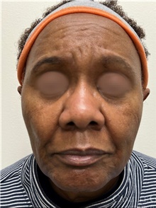 Dermal Fillers Before Photo by Camille Cash, MD; Houston, TX - Case 47758