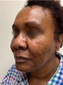 Dermal Fillers After Photo by Camille Cash, MD; Houston, TX - Case 47758