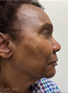 Dermal Fillers After Photo by Camille Cash, MD; Houston, TX - Case 47758
