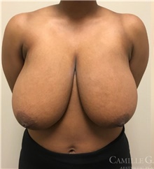 Q & A: How Does a Breast Lift Work? - Camille Cash, M.D.