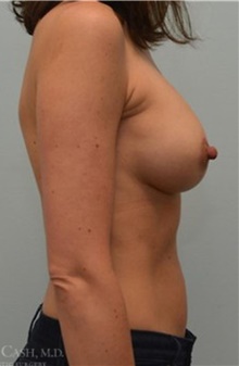 Breast Lift After Photo by Camille Cash, MD; Houston, TX - Case 47761