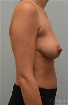 Breast Lift Before Photo by Camille Cash, MD; Houston, TX - Case 47761