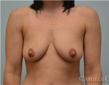 Breast Augmentation Before Photo by Camille Cash, MD; Houston, TX - Case 47762