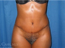 Tummy Tuck After Photo by Camille Cash, MD; Houston, TX - Case 47763