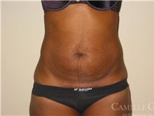 Tummy Tuck Before Photo by Camille Cash, MD; Houston, TX - Case 47763