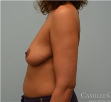 Breast Augmentation Before Photo by Camille Cash, MD; Houston, TX - Case 47765