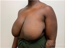 Breast Reduction Before Photo by Camille Cash, MD; Houston, TX - Case 47766