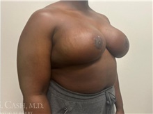 Breast Reduction After Photo by Camille Cash, MD; Houston, TX - Case 47766