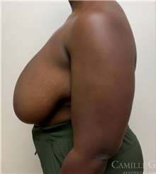 Breast Reduction Before Photo by Camille Cash, MD; Houston, TX - Case 47766