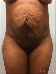 Tummy Tuck Before Photo by Camille Cash, MD; Houston, TX - Case 47818