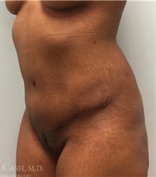 Tummy Tuck After Photo by Camille Cash, MD; Houston, TX - Case 47818