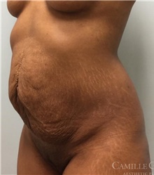 Tummy Tuck Before Photo by Camille Cash, MD; Houston, TX - Case 47818
