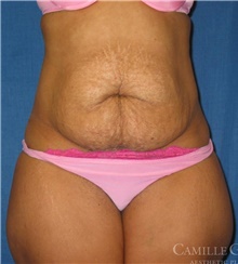Tummy Tuck Before Photo by Camille Cash, MD; Houston, TX - Case 47849