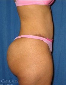 Tummy Tuck After Photo by Camille Cash, MD; Houston, TX - Case 47849