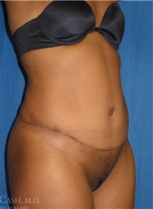 Tummy Tuck After Photo by Camille Cash, MD; Houston, TX - Case 47865