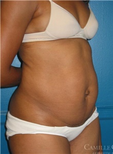 Tummy Tuck Before Photo by Camille Cash, MD; Houston, TX - Case 47865