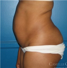 Tummy Tuck Before Photo by Camille Cash, MD; Houston, TX - Case 47865