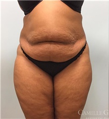 Tummy Tuck Recovery: What To Expect - Camille Cash, M.D.