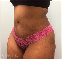 Tummy Tuck After Photo by Camille Cash, MD; Houston, TX - Case 47866