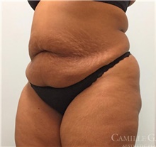 Tummy Tuck Before Photo by Camille Cash, MD; Houston, TX - Case 47866