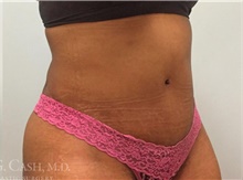 Tummy Tuck After Photo by Camille Cash, MD; Houston, TX - Case 47866
