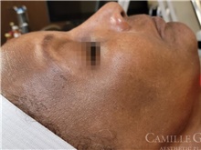 Chemical Peels, IPL, Fractional CO2 Laser Treatments Before Photo by Camille Cash, MD; Houston, TX - Case 47868