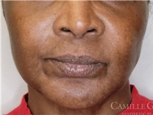 Chemical Peels, IPL, Fractional CO2 Laser Treatments Before Photo by Camille Cash, MD; Houston, TX - Case 47868