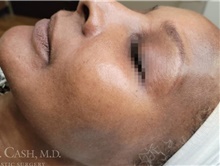 Chemical Peels, IPL, Fractional CO2 Laser Treatments After Photo by Camille Cash, MD; Houston, TX - Case 47868