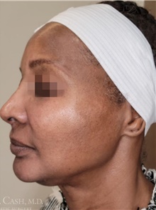 Chemical Peels, IPL, Fractional CO2 Laser Treatments After Photo by Camille Cash, MD; Houston, TX - Case 47868
