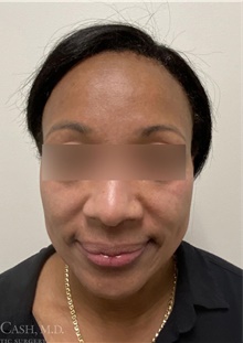 Chemical Peels, IPL, Fractional CO2 Laser Treatments After Photo by Camille Cash, MD; Houston, TX - Case 47869