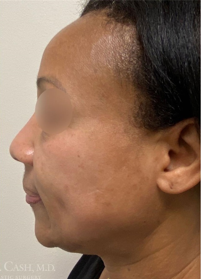 CO2 LASER TREATMENT BEFORE & AFTER PHOTOS