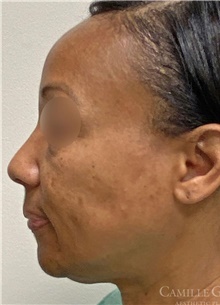 Chemical Peels, IPL, Fractional CO2 Laser Treatments Before Photo by Camille Cash, MD; Houston, TX - Case 47869
