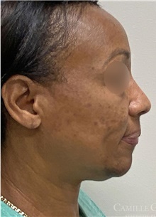 Chemical Peels, IPL, Fractional CO2 Laser Treatments Before Photo by Camille Cash, MD; Houston, TX - Case 47869