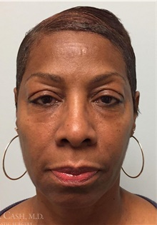 Injectable Fillers and Fat Transfer to the Face After Photo by Camille Cash, MD; Houston, TX - Case 47870