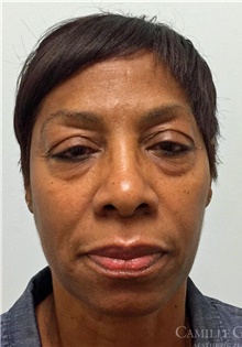 Injectable Fillers and Fat Transfer to the Face Before Photo by Camille Cash, MD; Houston, TX - Case 47870