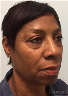 Injectable Fillers and Fat Transfer to the Face Before Photo by Camille Cash, MD; Houston, TX - Case 47870