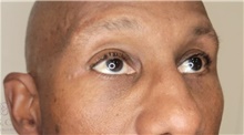 Eyelid Surgery After Photo by Camille Cash, MD; Houston, TX - Case 48034